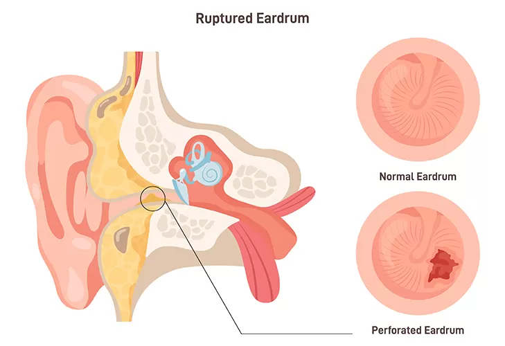 Eardrum Perforation Symptoms Treatment Options Pinnacle ENT 